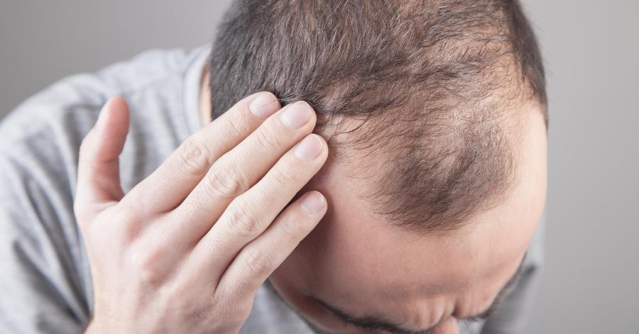 What to do about baldness